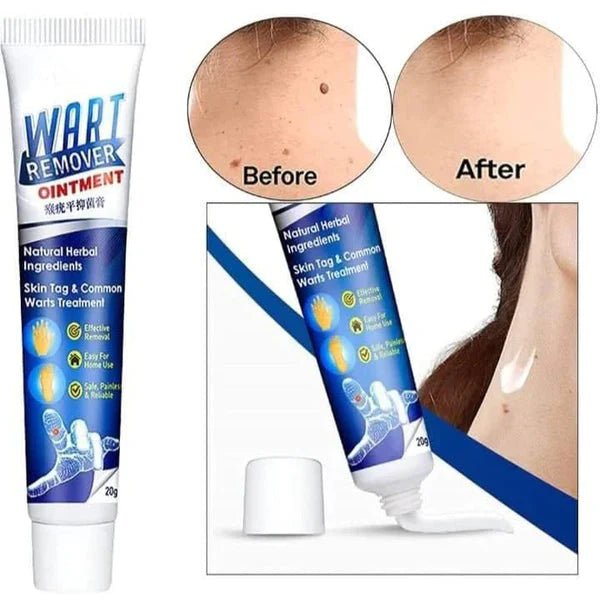 Wart Remover Cream - Dreamzhub