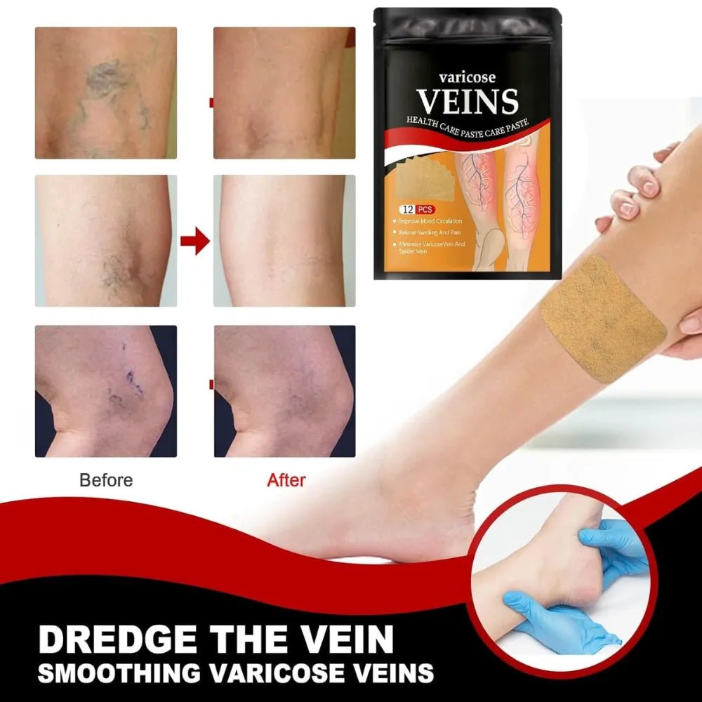Varicose Veins Health Care Paste | Pain Relief & Blood Circulation Support - Dreamzhub