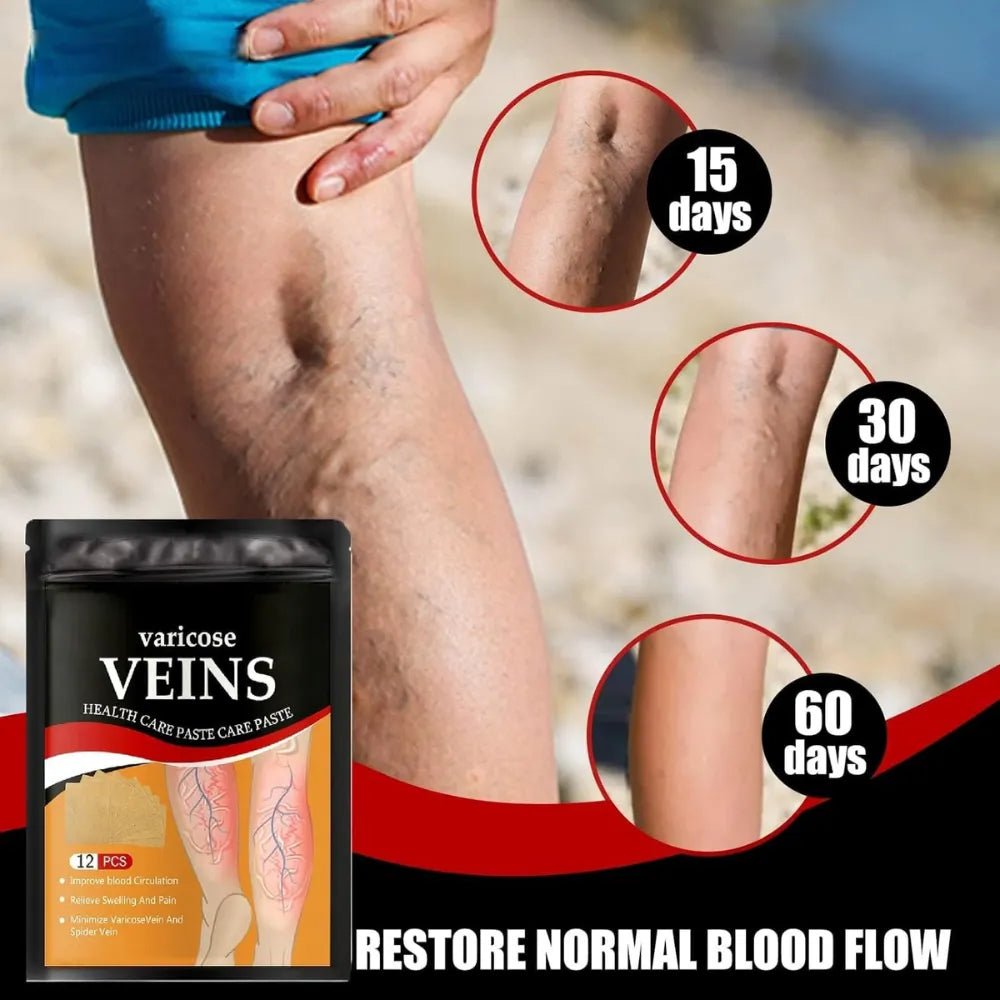 Varicose Veins Health Care Paste | Pain Relief & Blood Circulation Support - Dreamzhub