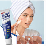 Wart Remover Cream - Dreamzhub